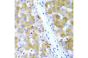 Immunohistochemistry of paraffin-embedded human liver cancer using TIRAP antibody at dilution of 1:200 (40x lens). (TIRAP anticorps)