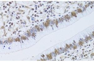 Immunohistochemistry of paraffin-embedded Human gastric cancer using LMNB2 Polyclonal Antibody at dilution of 1:100 (40x lens). (Lamin B2 anticorps)