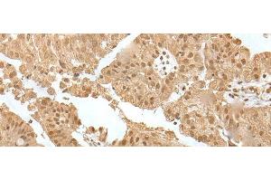 Immunohistochemistry of paraffin-embedded Human liver cancer tissue using ZNF24 Polyclonal Antibody at dilution of 1:35(x200) (ZNF24 anticorps)
