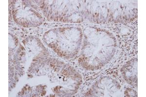 IHC-P Image STK24 antibody [N2C1], Internal detects STK24 protein at cytosol and nucleus on human breast carcinoma by immunohistochemical analysis. (STK24 anticorps)