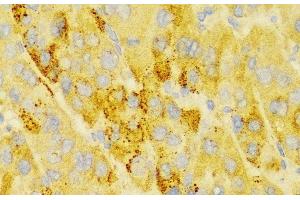 Immunohistochemistry of paraffin-embedded Human liver cancer using LAMP3 Polyclonal Antibody at dilution of 1:100 (40x lens). (LAMP3 anticorps)