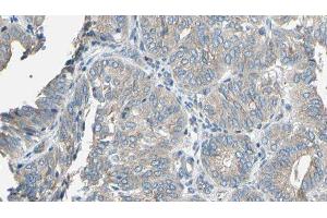 ABIN6277142 at 1/100 staining Human cervical cancer tissue by IHC-P. (CYP2E1 anticorps  (Internal Region))