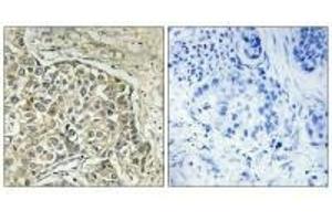 Immunohistochemistry analysis of paraffin-embedded human lung carcinoma tissue using ARSD antibody. (Arylsulfatase D anticorps)