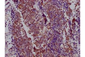 IHC image of ABIN7127859 diluted at 1:100 and staining in paraffin-embedded human lung cancer performed on a Leica BondTM system. (Recombinant NKX2-1 anticorps)
