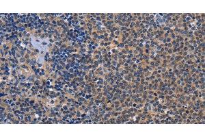 Immunohistochemistry of paraffin-embedded Human Lymphoma tissue using GDF11 Polyclonal Antibody at dilution 1:30 (GDF11 anticorps)