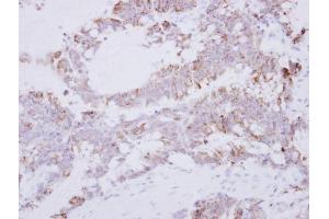 IHC-P Image Immunohistochemical analysis of paraffin-embedded human colon carcinoma, using GRAP2, antibody at 1:500 dilution. (GRAP2 anticorps)