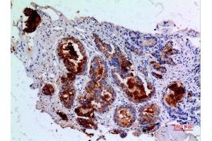 Immunohistochemistry (IHC) analysis of paraffin-embedded Human Prostatic Cancer, antibody was diluted at 1:100. (Angiopoietin 1 anticorps  (N-Term))