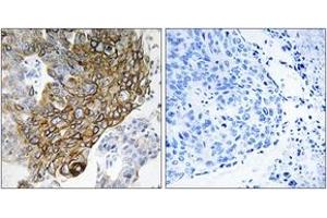 Immunohistochemistry analysis of paraffin-embedded human lung carcinoma tissue, using GJA3 Antibody. (GJA3 anticorps  (AA 151-200))