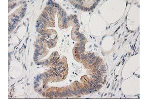 Immunohistochemical staining of paraffin-embedded Adenocarcinoma of Human colon tissue using anti-PLEKHA3 mouse monoclonal antibody. (PLEKHA3 anticorps)