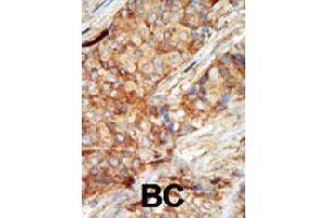 Formalin-fixed and paraffin-embedded human cancer tissue reacted with GCK polyclonal antibody  , which was peroxidase-conjugated to the secondary antibody, followed by AEC staining.