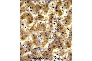 Formalin-fixed and paraffin-embedded human hepatocarcinoma reacted with ADH1B Antibody (Center), which was peroxidase-conjugated to the secondary antibody, followed by DAB staining.