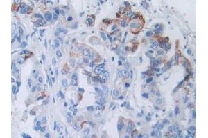 Detection of NCCT in Human Breast cancer Tissue using Polyclonal Antibody to Na-Cl Cotransporter (NCCT)