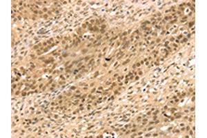 The image on the left is immunohistochemistry of paraffin-embedded Human breast cancer tissue using ABIN7131203(STAG2 Antibody) at dilution 1/35, on the right is treated with fusion protein. (STAG2 anticorps)