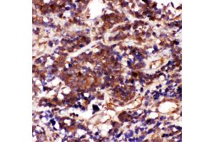 Anti-Caspase3 antibody, IHC(P) IHC(P): Human Lung Cancer Tissue