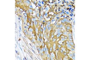 Immunohistochemistry of paraffin-embedded human lung squamous carcinoma tissue using Involucrin Rabbit mAb (ABIN6128025, ABIN6141815, ABIN6141818 and ABIN7101419) at dilution of 1:100 (40x lens).