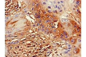 Immunohistochemistry of paraffin-embedded human cervical cancer using ABIN7164355 at dilution of 1:100 (DDX4 anticorps  (AA 1-223))