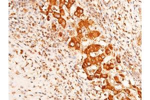ABIN6267221 at 1/100 staining human lung cancer tissue sections by IHC-P.