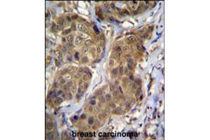 RNF11 Antibody immunohistochemistry analysis in formalin fixed and paraffin embedded human breast carcinoma followed by peroxidase conjugation of the secondary antibody and DAB staining.