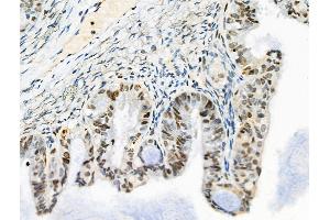 ABIN6257614 and ABIN6275206 at 1/100 staining Human ovarian cancer by IHC-P. (LRRC41 anticorps  (Internal Region))