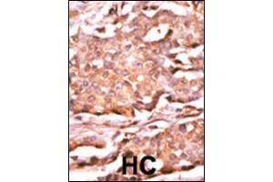 Formalin-fixed and paraffin-embedded human cancer tissue reacted with the primary antibody, which was peroxidase-conjugated to the secondary antibody, followed by AEC staining.