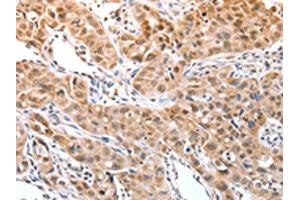 The image on the left is immunohistochemistry of paraffin-embedded Human lung cancer tissue using ABIN7129251(DPPA2 Antibody) at dilution 1/30, on the right is treated with fusion protein. (DPPA2 anticorps)