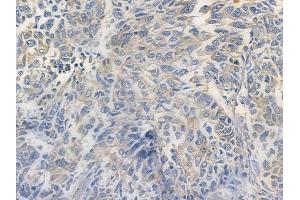 C1orf43 Antibody at 1/100 staining human lung squamous cell carcinoma by IHC-P. (C1orf43 anticorps)