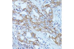 Immunohistochemistry of paraffin-embedded human lung cancer using FGD1 antibody (ABIN7267284) at dilution of 1:100 (40x lens). (FGD1 anticorps  (AA 700-800))