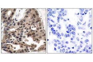 Immunohistochemical analysis of paraffin-embedded human breast carcinoma tissue using 4E-BP1 (Ab-36) antibody (E021215). (eIF4EBP1 anticorps)