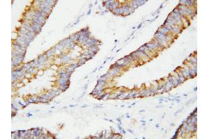 Anti-BCAT2 antibody, IHC(P) IHC(P): Human Colon Cancer Tissue