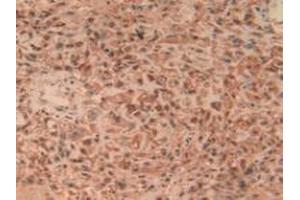 IHC-P analysis of Human Lung Cancer Tissue, with DAB staining. (UCHL1 anticorps  (C-Term))