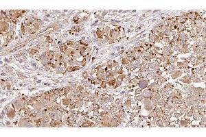 ABIN6269006 at 1/100 staining Human melanoma tissue by IHC-P. (Metabotropic Glutamate Receptor 6 anticorps  (C-Term))