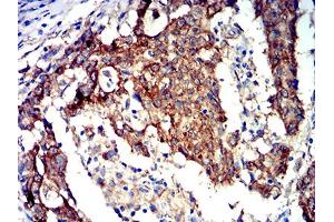 Immunohistochemical analysis of paraffin-embedded stomach cancer tissues using PRKAA2 mouse mAb with DAB staining.