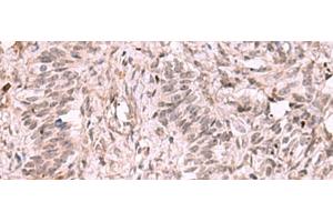 Immunohistochemistry of paraffin-embedded Human ovarian cancer tissue using KDM7A Polyclonal Antibody at dilution of 1:35(x200) (JHDM1D anticorps)