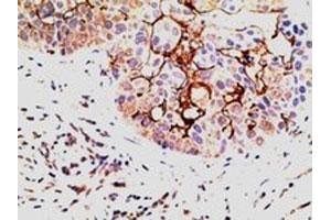 EPS8 polyclonal antibody (Cat # PAB6473, 5 ug/mL) staining of paraffin embedded human breast Carcinoma. (EPS8 anticorps)
