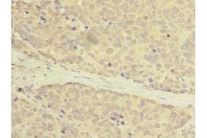 Immunohistochemistry of paraffin-embedded human gastric cancer using ABIN7175069 at dilution of 1: 100 (C2orf27A anticorps  (AA 3-174))