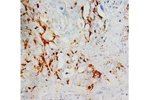 Immunohistochemical analysis of paraffin embedded Mammary cancer sections, staining HIF-1alpha in cytoplasm, DAB chromogenic reaction