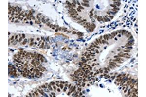 The image on the left is immunohistochemistry of paraffin-embedded Human colon cancer tissue using ABIN7191321(LRP5 Antibody) at dilution 1/55, on the right is treated with synthetic peptide. (LRP5 anticorps)