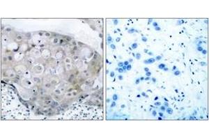 Immunohistochemistry analysis of paraffin-embedded human breast carcinoma, using VEGFR2 (Phospho-Tyr951) Antibody.