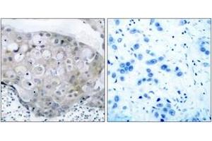 Immunohistochemistry analysis of paraffin-embedded human breast carcinoma, using VEGFR2 (Phospho-Tyr951) Antibody. (VEGFR2/CD309 anticorps  (pTyr951))