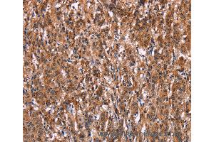 Immunohistochemistry of Human liver cancer using LILRB1 Polyclonal Antibody at dilution of 1:50 (LILRB1 anticorps)