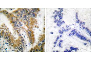 Peptide - +Immunohistochemical analysis of paraffin-embedded human lung carcinoma tissue, using CrkL (Ab-207) antibody (#B0067). (CrkL anticorps  (Tyr207))