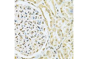 Immunohistochemistry of paraffin-embedded human kidney cancer using HNRNPA2B1 Antibody. (HNRNPA2B1 anticorps  (AA 1-180))