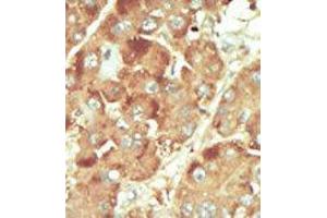 Formalin-fixed and paraffin-embedded human cancer tissue reacted with the primary antibody, which was peroxidase-conjugated to the secondary antibody, followed by DAB staining. (Nemo-Like Kinase anticorps  (C-Term))