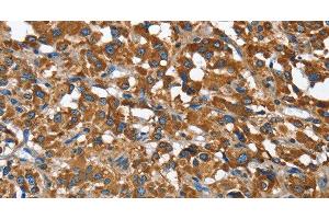 Immunohistochemistry of paraffin-embedded Human thyroid cancer using BGN Polyclonal Antibody at dilution of 1:50