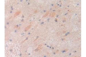 Detection of CHRD in Human Glioma Tissue using Polyclonal Antibody to Chordin (CHRD)
