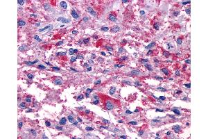 Anti-P2RY11 / P2Y11 antibody IHC of human Brain, Glioblastoma.