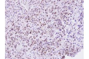 IHC-P Image Immunohistochemical analysis of paraffin-embedded SAS Xenograft , using ZHX2, antibody at 1:100 dilution. (ZHX2 anticorps  (C-Term))