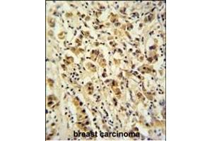 DDX49 Antibody (C-term) (ABIN653921 and ABIN2843155) immunohistochemistry analysis in formalin fixed and paraffin embedded human breast carcinoma followed by peroxidase conjugation of the secondary antibody and DAB staining. (DDX49 anticorps  (C-Term))