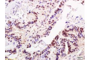 Formalin-fixed and paraffin embedded human colon carcinoma labeled with Anti-TRF2 Polyclonal Antibody, Unconjugated (ABIN736418) at 1:200 followed by conjugation to the secondary antibody and DAB staining (TBPL1 anticorps  (AA 301-400))