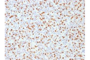 Formalin-fixed, paraffin-embedded human Hodgkin's Lymphoma stained with PU.